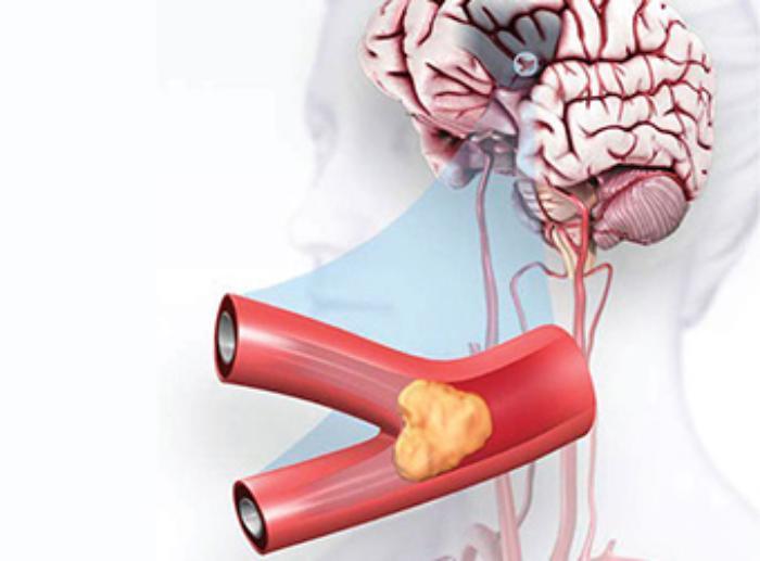 stroke_340x241.jpg